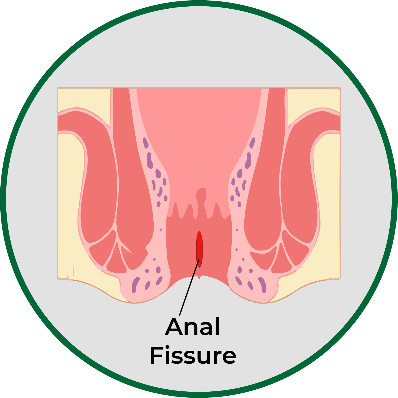 Fissure