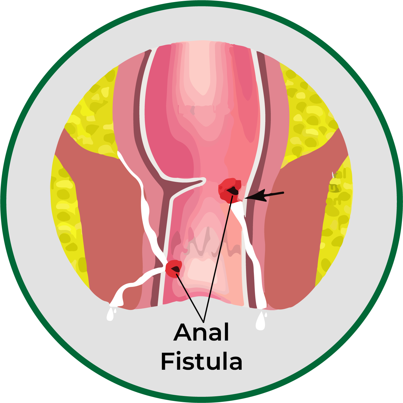 anal fistula