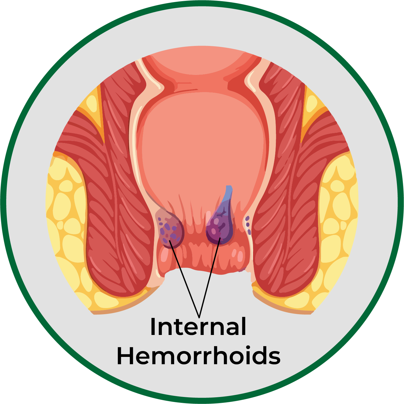 Internal hemorrhoid