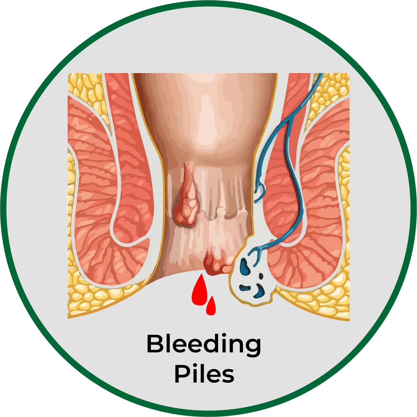 Bleeding piles